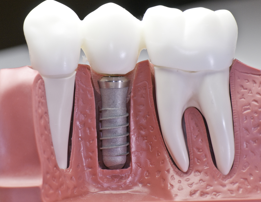 Everything to know about dental implants in Hawkesbury